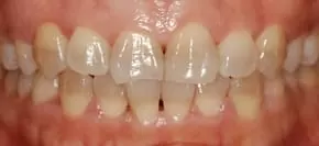 告別黃板牙全口美白瓷貼片,恢復牙齒功能及美觀 告別黃板牙全口美白瓷貼片,恢復牙齒功能及美觀