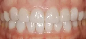 告別黃板牙全口美白瓷貼片,恢復牙齒功能及美觀 告別黃板牙全口美白瓷貼片,恢復牙齒功能及美觀