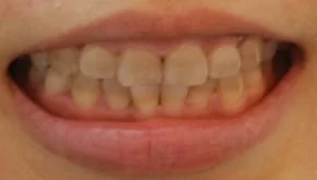 告別黃板牙全口美白瓷貼片,恢復牙齒功能及美觀 告別黃板牙全口美白瓷貼片,恢復牙齒功能及美觀