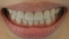 告別黃板牙全口美白瓷貼片,恢復牙齒功能及美觀 告別黃板牙全口美白瓷貼片,恢復牙齒功能及美觀