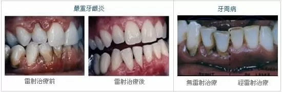 牙周基本治療 (非手術治療) 牙周基本治療 (非手術治療)